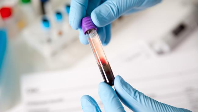 Point-of-Care High-Sensitivity Assay for Troponin I Compares Well With Central Labs